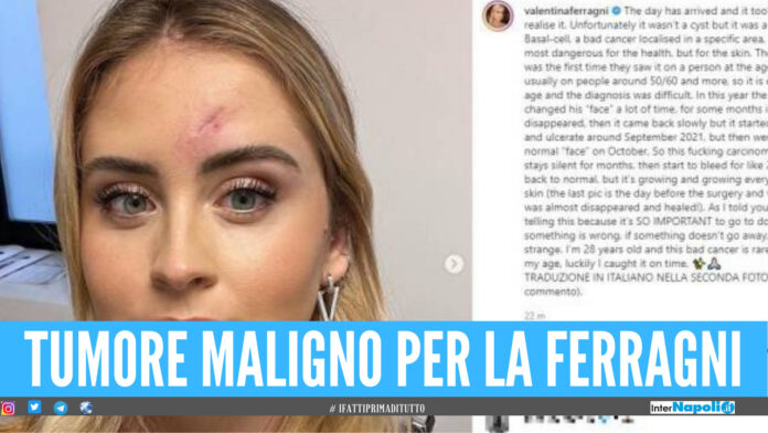 Valentina Ferragni, il dramma Non è un brufolo ma un tumore maligno