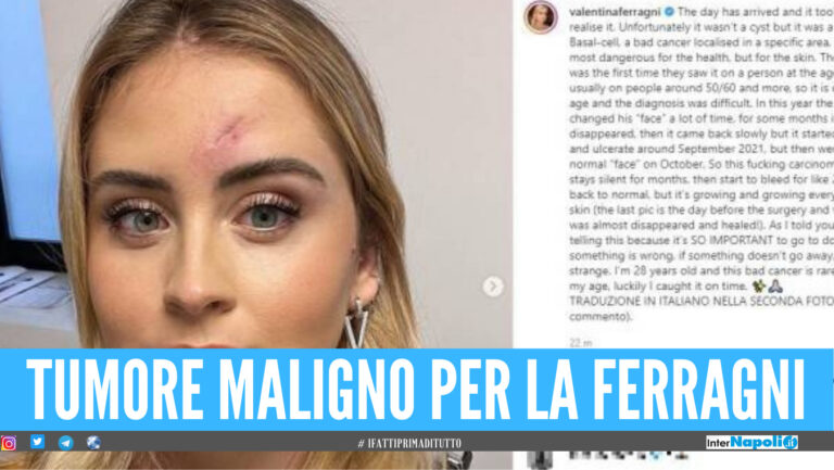 Valentina Ferragni, il dramma: “Non è un brufolo ma un tumore maligno”