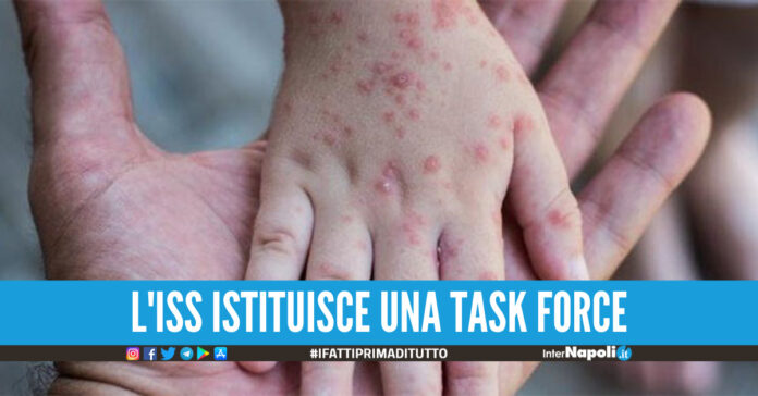 Vaiolo delle scimmie, in Italia c'è il primo caso: paziente trasferito allo Spallanzani