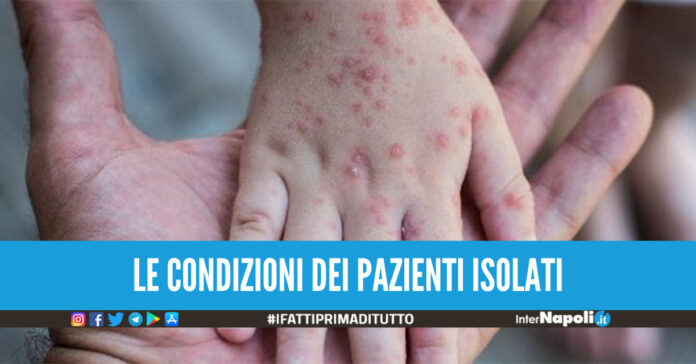 Vaiolo delle scimmie in Italia, come riconoscere i sintomi del virus: 