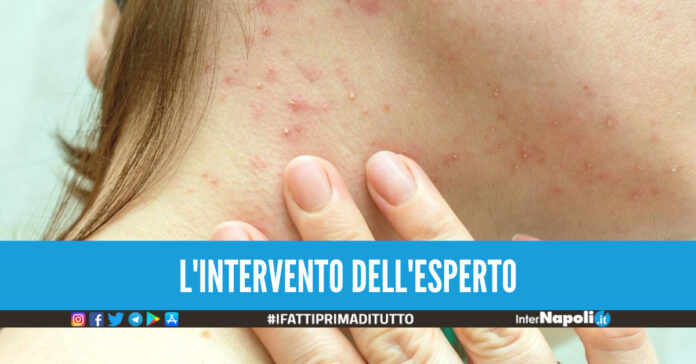 Vaiolo delle scimmie meno grave di una varicella: 