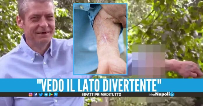Pene attaccato al braccio, operato dopo 6 anni Finalmente è tornato al suo posto