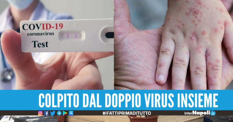 Contrae contemporaneamente il coronavirus e il vaiolo delle scimmie, è il primo caso al mondo