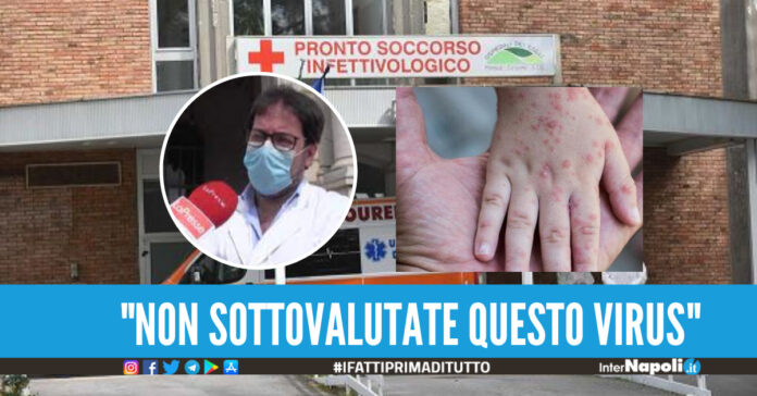 Vaiolo delle scimmie, 14 i casi in Campania. L'appello dal Cotugno di Napoli Serve responsabilità