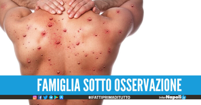 Vaiolo delle scimmie