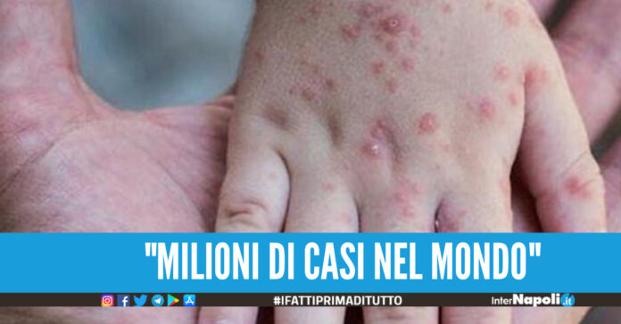 Vaiolo delle scimmie