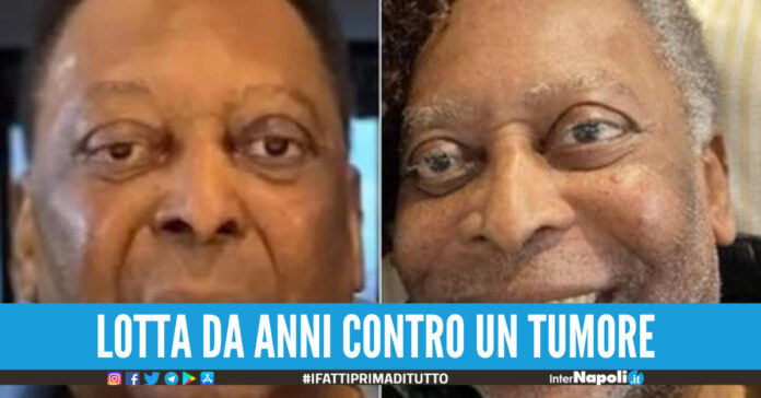 Pelè, condizioni sempre pià critiche: 