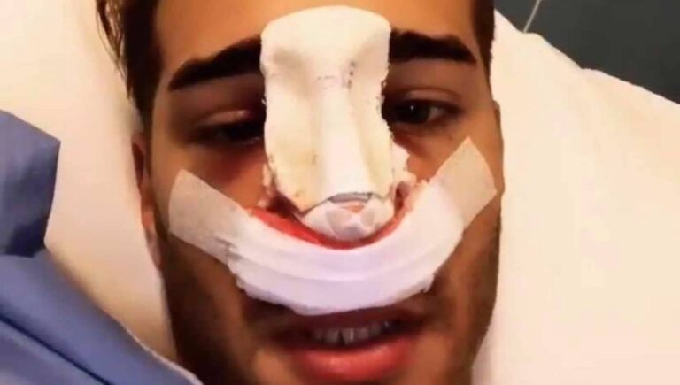 Niccolò Ferrari si è rifatto il naso in Tunisia, su Instagram la foto dopo l’intervento