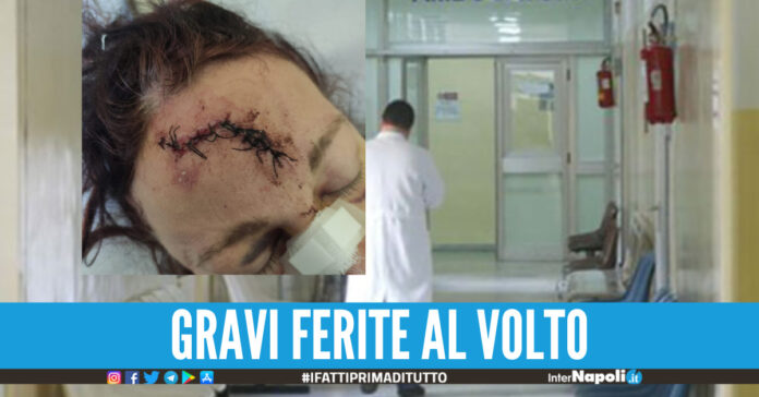 Ragazza travolta da uno scooter a Napoli era senza assicurazione e trasportava una scala