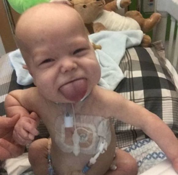 Il bimbo con la lingua che non smette di crescere: operato per poter mangiare e respirare