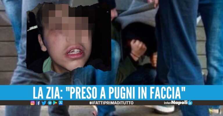 Violenza a Torre del Greco, bimbo di 11 anni picchiato con un tirapugni