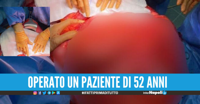 Asportato un sarcoma di 30 kg, è uno dei tumori più grandi in Europa