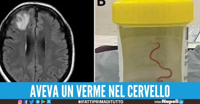 Mentre la operano trovano un verme vivo di 8 cm nel cervello di una donna.