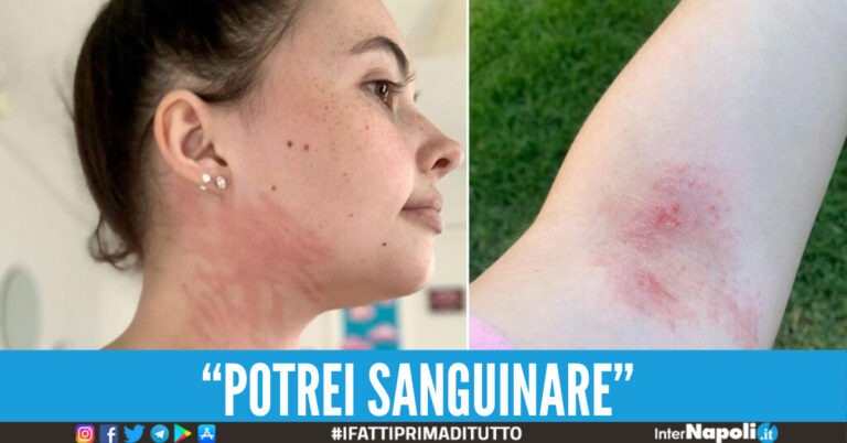 Allergica all'acqua