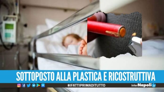 Perde tre dita per un botto illegale, bimbo ricoverato in ospedale