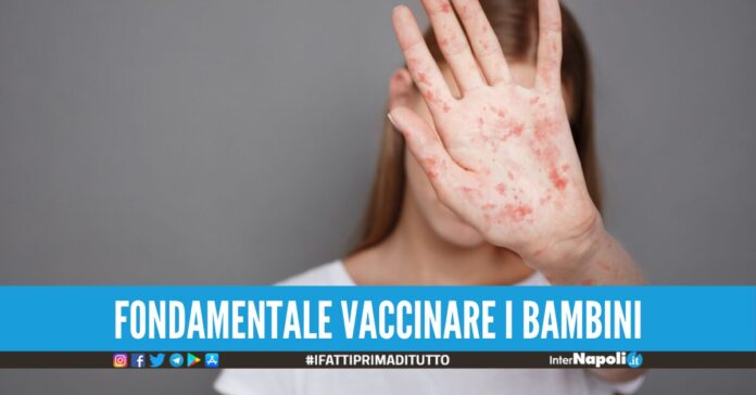 morbillo
