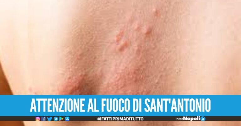 “Vaccinarsi contro il fuoco di Sant’Antonio”. i consigli del Cardarelli