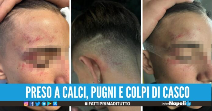 Terrore in strada a Quarto, picchiato dal branco mentre passeggiava con la fidanzatina