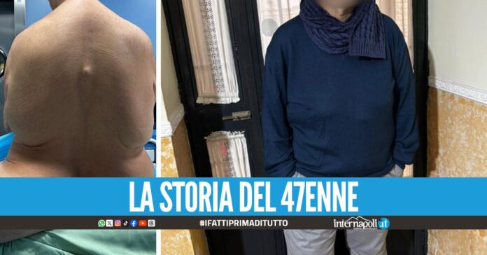 Convive per 13 anni con l’intestino nel gluteo e nella gamba, l'incredibile intervento al Monaldi