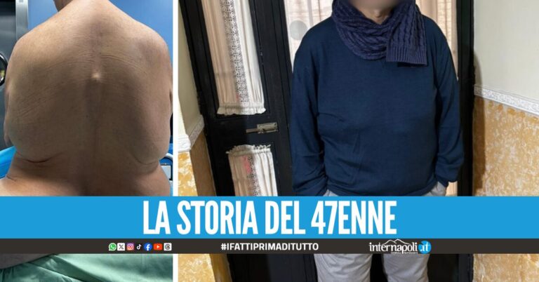 Convive per 13 anni con l’intestino nel gluteo e nella gamba, l'incredibile intervento al Monaldi