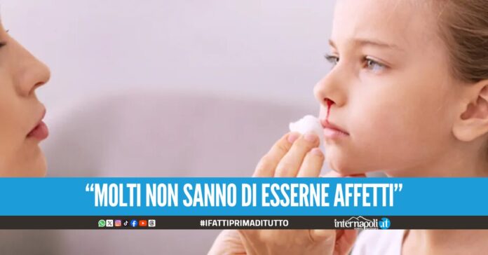 Cos'è l'HHT, la malattia rara con 150 casi in Campania