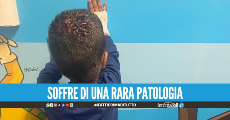 Da Gaza al Santobono, bimbo di 2 anni arriva a Napoli per le cure salvavita