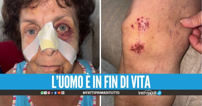 Coppia di anziani investiti a Salvator Rosa: "È stato un inferno"