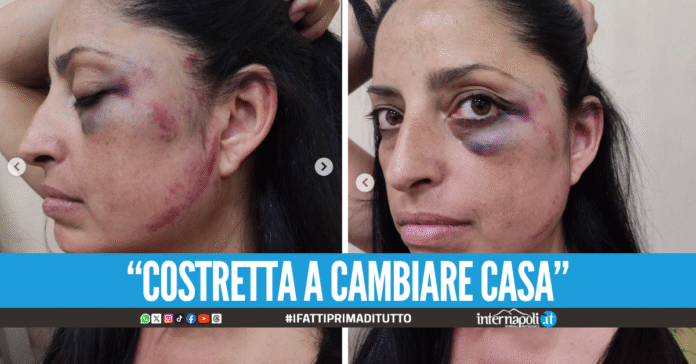 Choc a Chiaiano, donna presa a calci e pugni dall’ex fidanzato 18enne della figlia