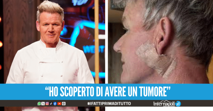 Lo chef Gordon Ramsey affetto da un tumore alla pelle, pubblica le foto del postoperatorio
