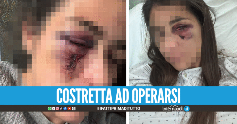 Massacrata di botte dal marito a Sant'Anastasia, la denuncia: "Lui è ancora libero"