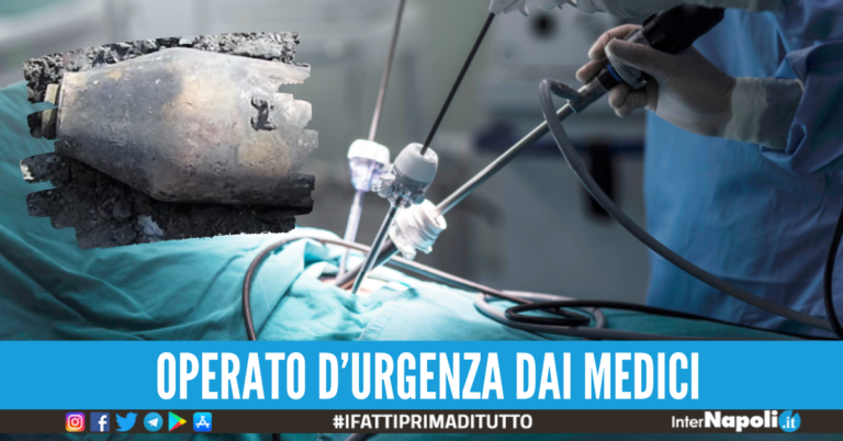 Operato d'urgenza per estrarre la bomba dal retto