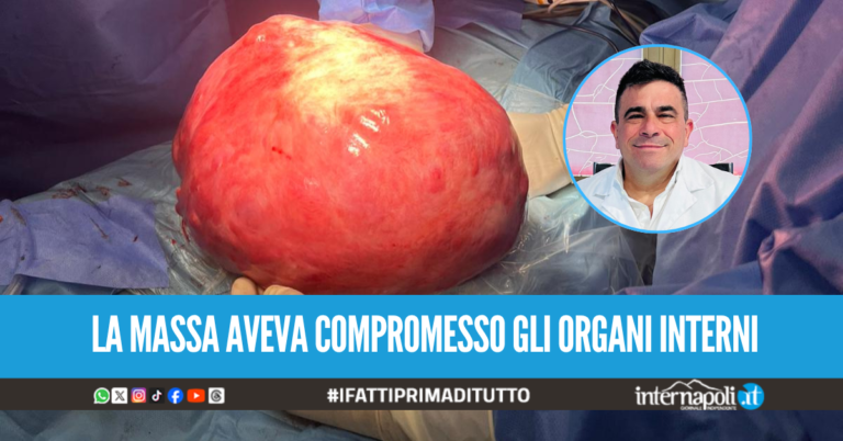 Intervento da record in clinica a Salerno, asportato un tumore addominale di 10 kg