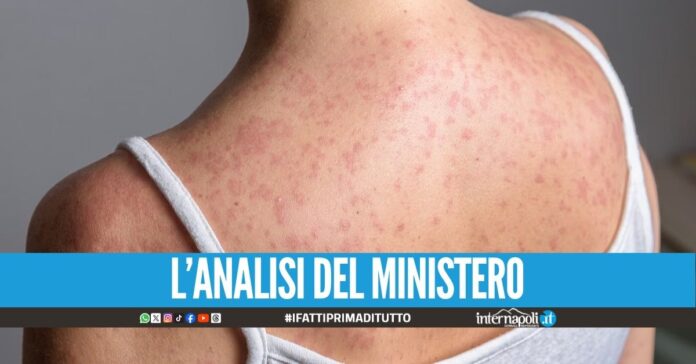 Aumentano i casi di morbillo, preoccupa la situazione in Campania